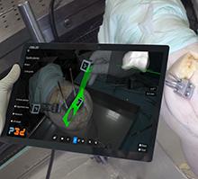 Close-up of a surgical tool or device being used in a medical procedure, representing Perceive3D’s innovative technology in enhancing precision during surgeries.