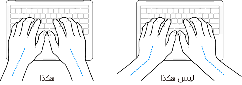 يدان موضوعتان على لوحة مفاتيح، وتظهر المحاذاة الصحيحة وغير الصحيحة للمعصم واليد.