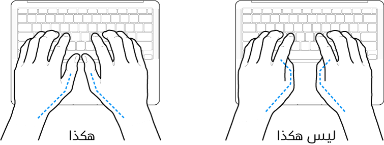 يدان موضوعتان على لوحة مفاتيح، ويظهر الوضع الصحيح وغير الصحيح للإبهامين.