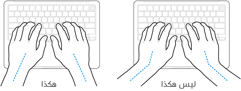يدان موضوعتان على لوحة مفاتيح، وتظهر المحاذاة الصحيحة وغير الصحيحة للمعصم واليد.