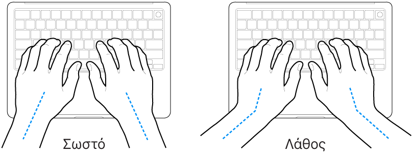 Χέρια τοποθετημένα επάνω σε ένα πληκτρολόγιο, που δείχνουν τη σωστή και τη λανθασμένη θέση των καρπών σε σχέση με τα χέρια.