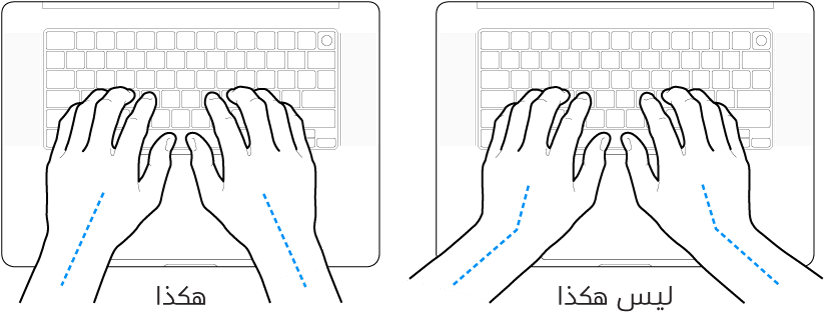 يدان موضوعتان على لوحة مفاتيح، وتظهر المحاذاة الصحيحة وغير الصحيحة للمعصم واليد.