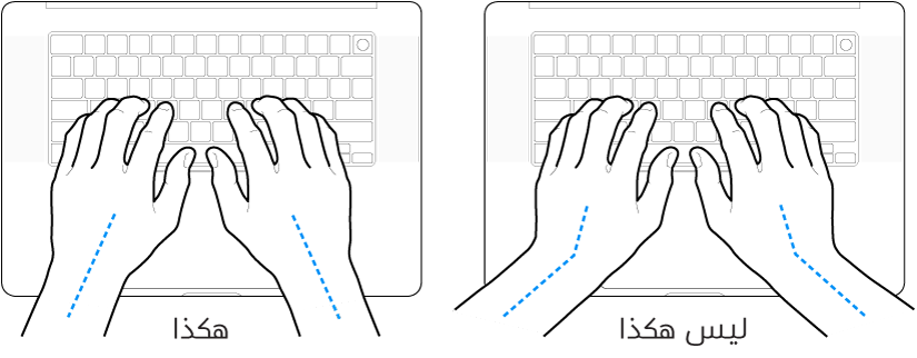 يدان موضوعتان على لوحة مفاتيح، وتظهر المحاذاة الصحيحة وغير الصحيحة للمعصم واليد.