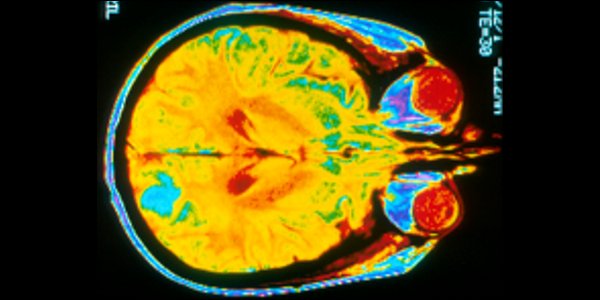 Brain MRI
