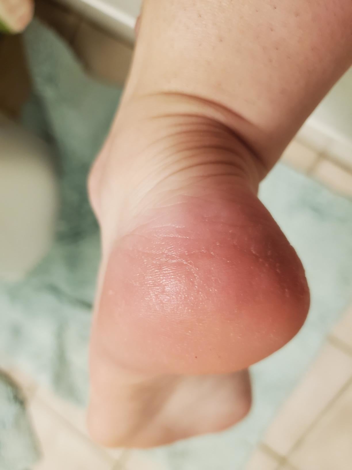 The same reviewer's heel looking smooth and callous-free after using the file