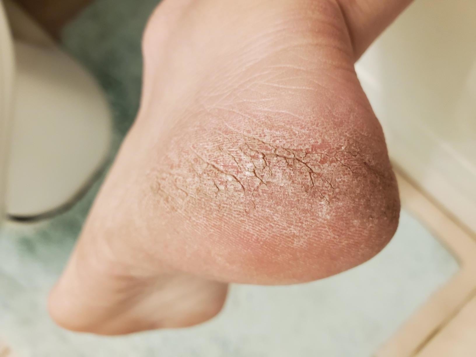 A reviewer's dry calloused heel