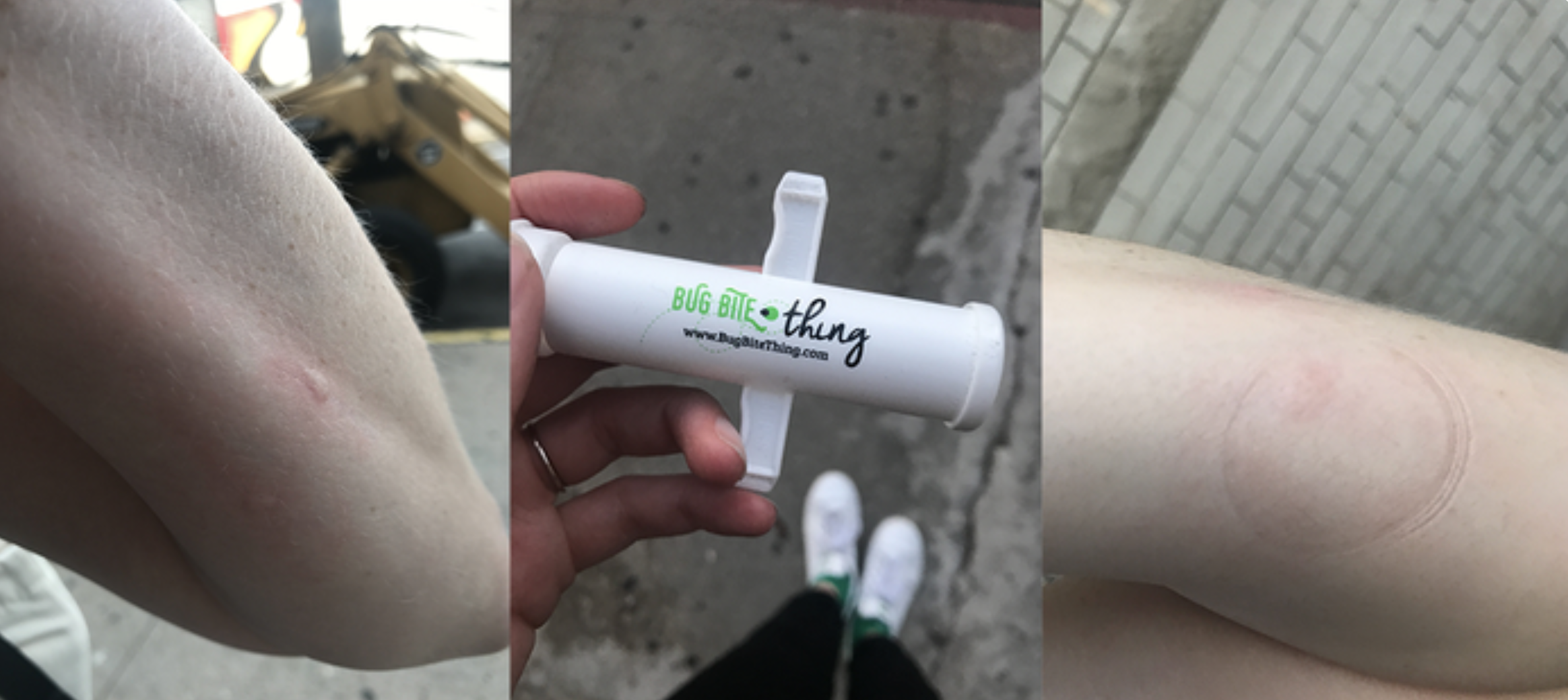 A BuzzFeed editor's arm with a bite on it, the editor holding the suction tool and an after of the swelling reduced on the editor's arm.