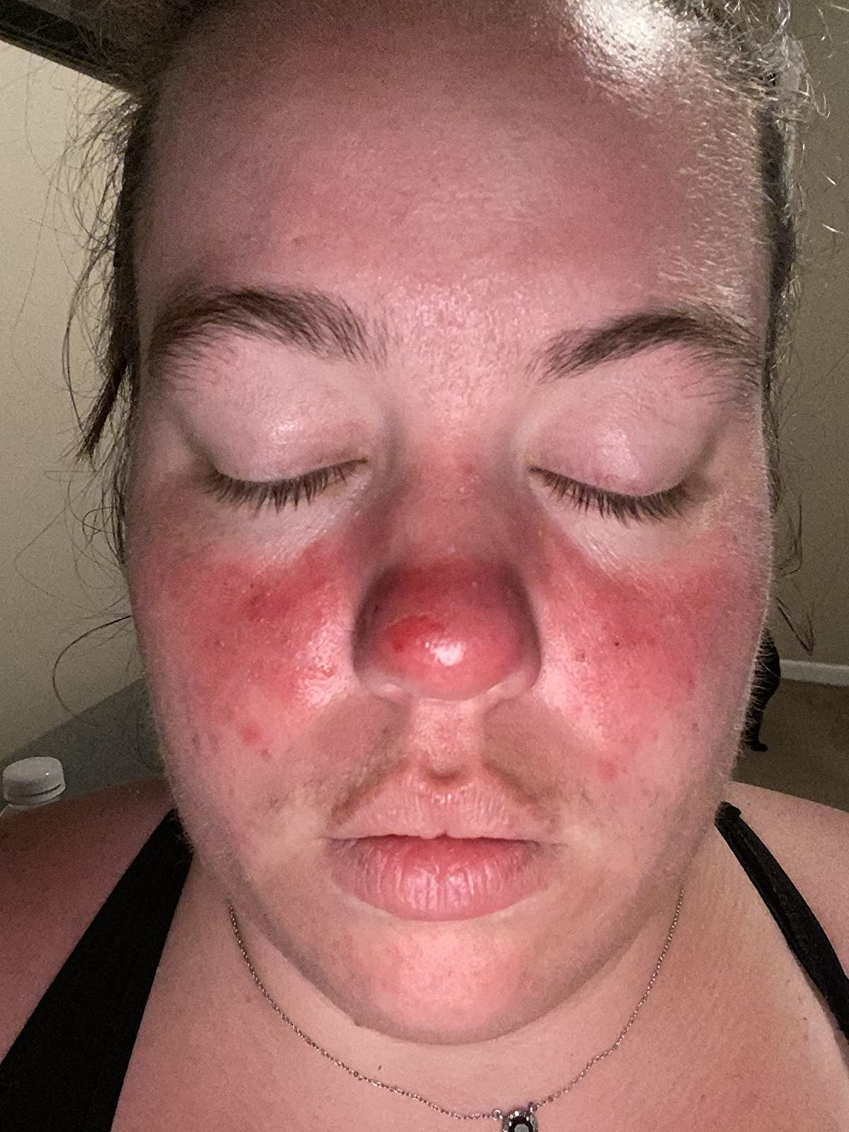 Reviewer's irritated skin before using the calming cream