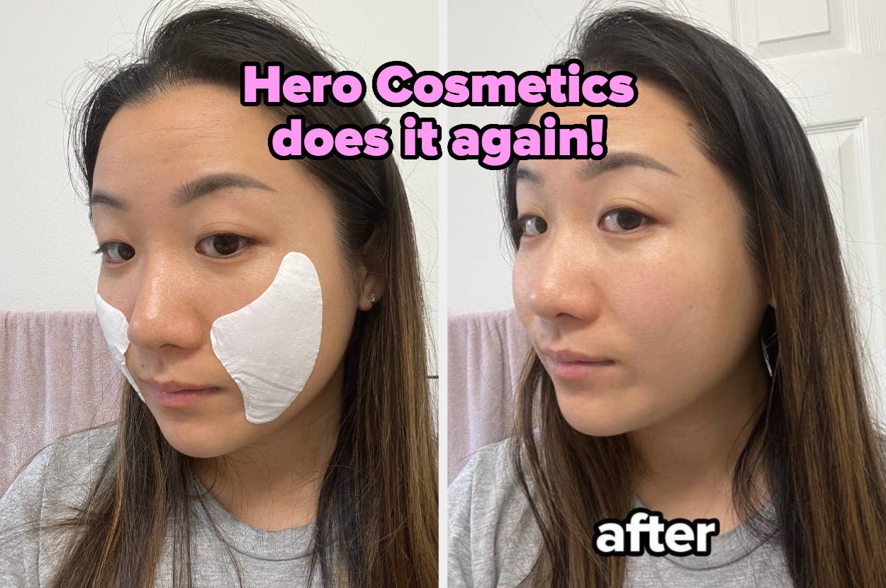 Side-by-side comparison of a woman using Hero Cosmetics skin care patches before and after. The text reads, "Hero Cosmetics does it again!" and "after."