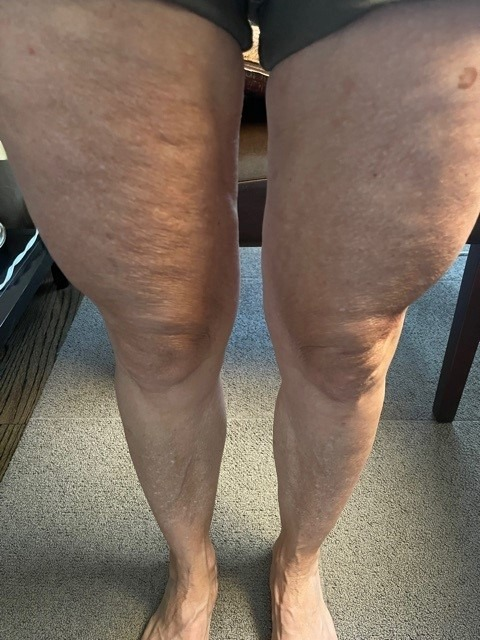 Close-up image of a person's legs showing dry and textured skin before using Bum Bum Cream