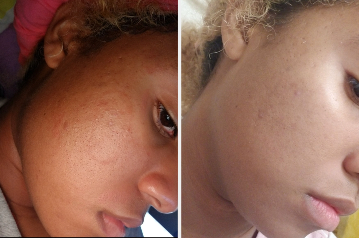 Before and after image of reviewer with acne that's less inflamed in the after pic