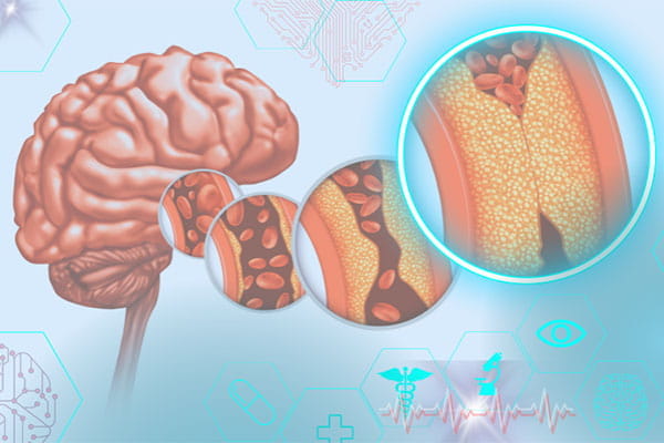 Illustration of brain showing example of blood clot ischemic stroke